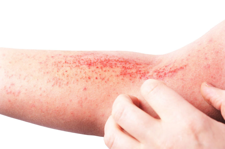 Vivere con la dermatite atopica