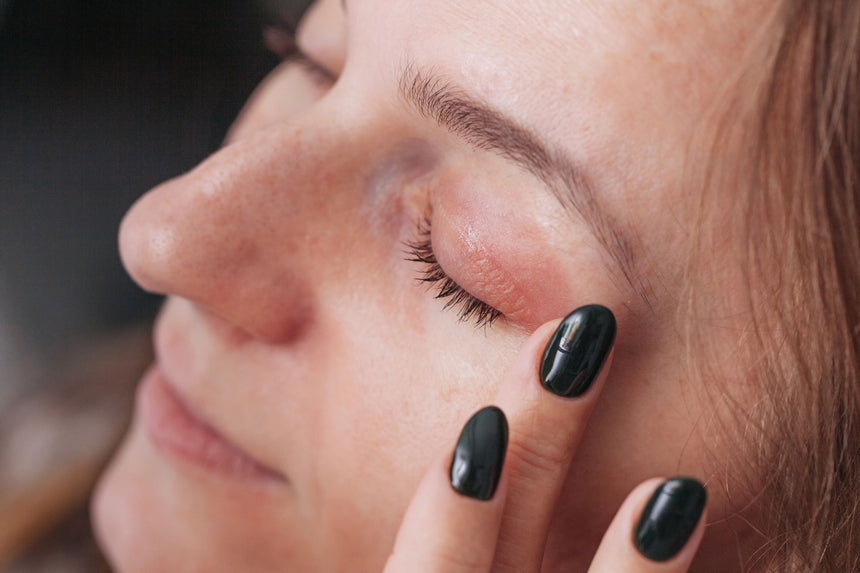 Dermatite palpebrale